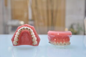 裏側矯正と表側矯正の歯の模型
