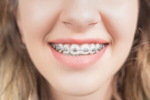 歯列矯正をしている歯を見せて笑う女性
