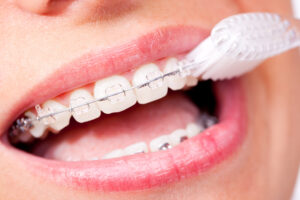 ワイヤー矯正している歯を歯ブラシで磨く女性の口元