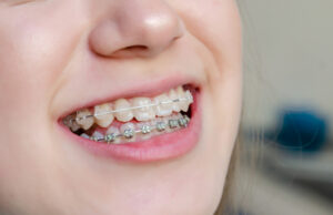 笑顔で矯正中の歯を見せる女性