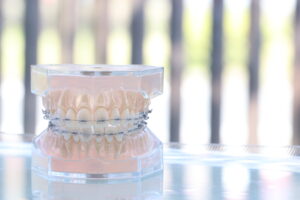 机に置かれたワイヤー矯正された歯の模型